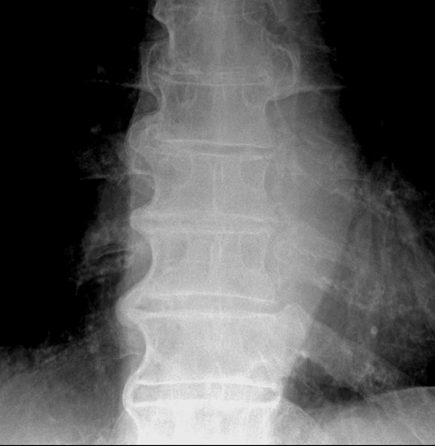 DISH Thoracic Vertebrae